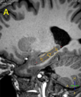 PEPSY | Neuropresage